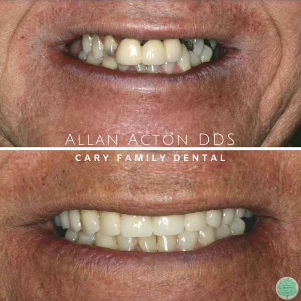 Screen Shot 2022-03-30 at 6.50.16 PM Before and after of a smile transformation at Cary Family Dental