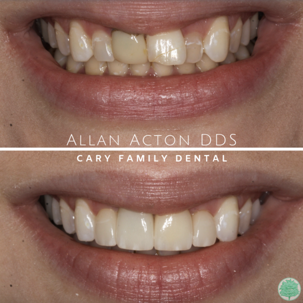 Screen Shot 2022-03-30 at 6.50.29 PM Before and after of a smile transformation at Cary Family Dental