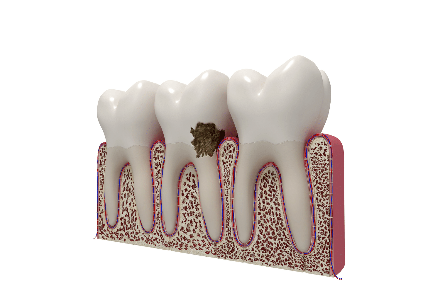 A demonstration of periodontal disease in a tooth