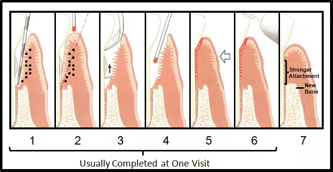 Visual diagram of Periodontal Disease Treatment steps at Cary Family Dental