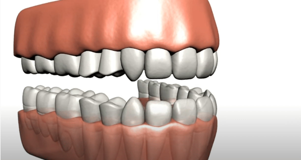 3d imaging of Teeth Whitening at Cary Family Dental