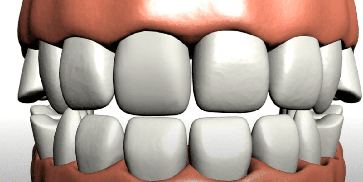 3d imaging of Porcelain veneers at Cary Family Dental