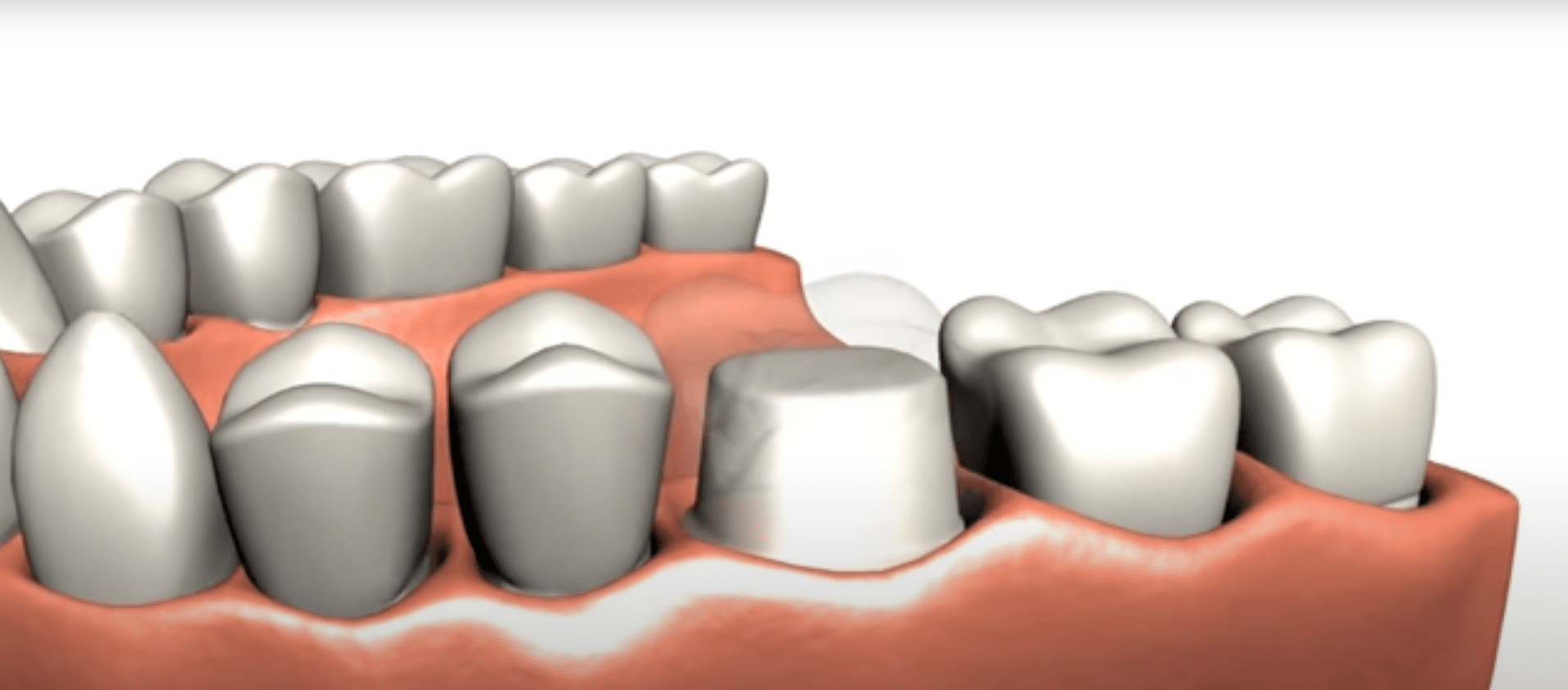 3d model of a Crown Preparation at Cary Family Dental