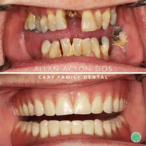 Before and after of traditional dentures at Cary Family Dental