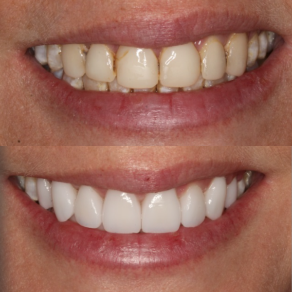 Before and After #1 Before and after of patients smile from Cary Family Dental Cosmetic Dentist in Cary, NC