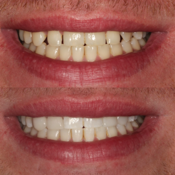 Before and After #11 Before and after of patients smile from Cary Family Dental Cosmetic Dentist in Cary, NC
