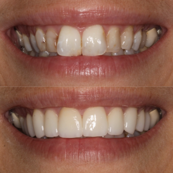Before and After #13 Before and after of patients smile from Cary Family Dental Cosmetic Dentist in Cary, NC