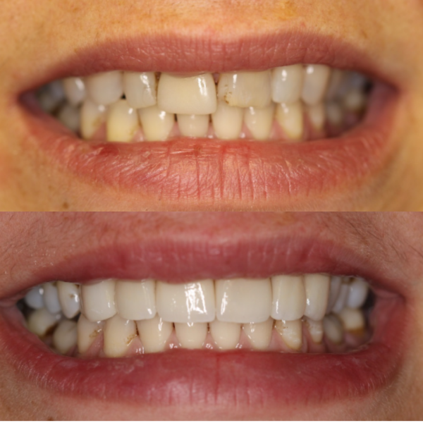 Before and After #16 Before and after of patients Broken Tooth from Cary Family Dental Cosmetic Dentist in Cary, NC