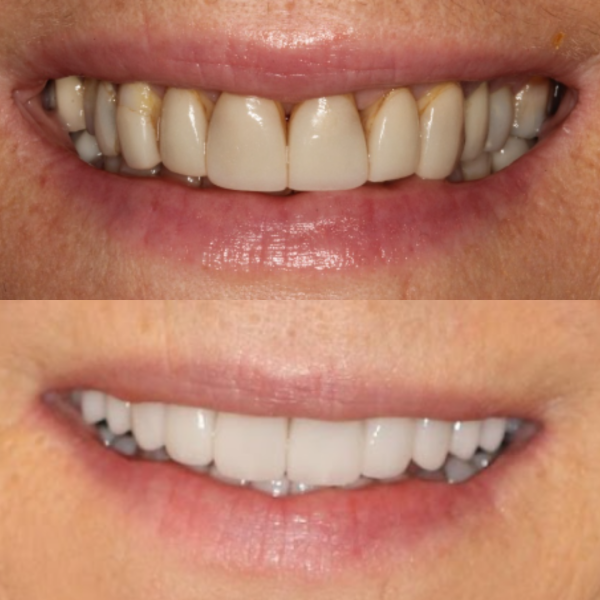 Before and After #18 Before and after of patients Teeth Whitening from Cary Family Dental Cosmetic Dentist in Cary, NC
