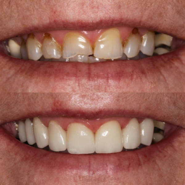 Before and After #20 Before and after of patients Smile Makeover from Cary Family Dental Cosmetic Dentist in Cary, NC