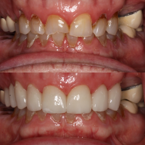 Before and After #21 Before and after of patients Smile Makeover from Cary Family Dental Cosmetic Dentist in Cary, NC