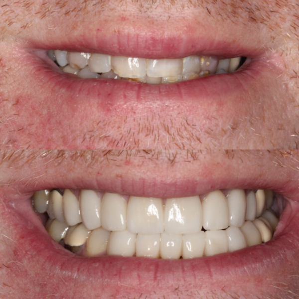 Before and After #23 Before and after of patients Smile Makeover from Cary Family Dental Cosmetic Dentist in Cary, NC