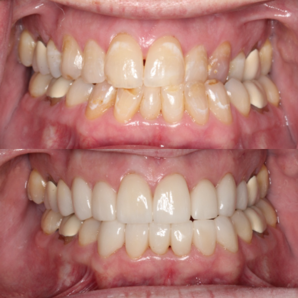 Before and After #24 Before and after of patients Smile Makeover from Cary Family Dental Cosmetic Dentist in Cary, NC