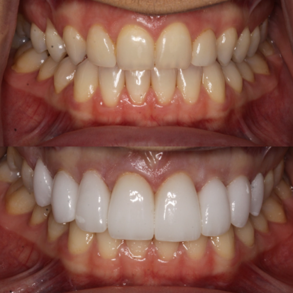Before and After #26 Before and after of patients Smile Makeover from Cary Family Dental Cosmetic Dentist in Cary, NC