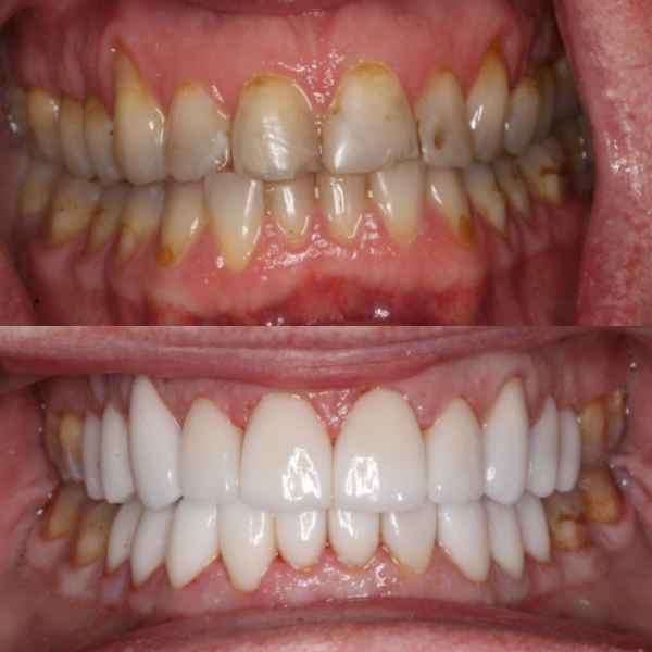 Before and After #27 Before and after of patients Smile Makeover from Cary Family Dental Cosmetic Dentist in Cary, NC
