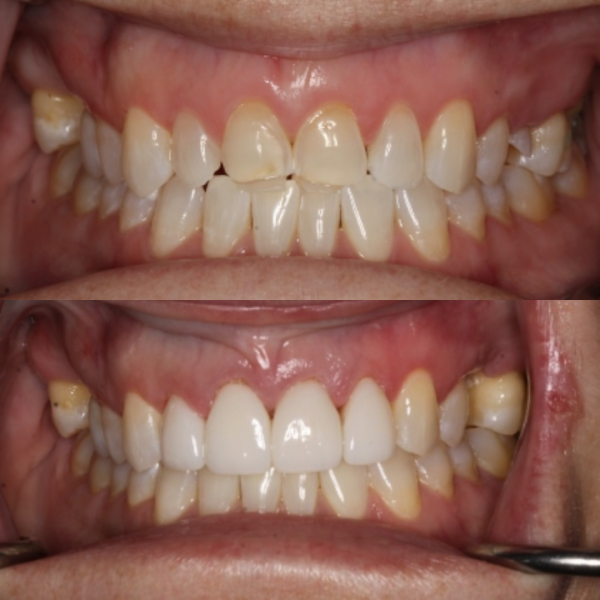 Before and After #29 Before and after of patients Teeth Whitening from Cary Family Dental Cosmetic Dentist in Cary, NC