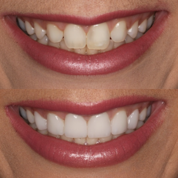 Before and After #3 Before and after of patients smile from Cary Family Dental Cosmetic Dentist in Cary, NC