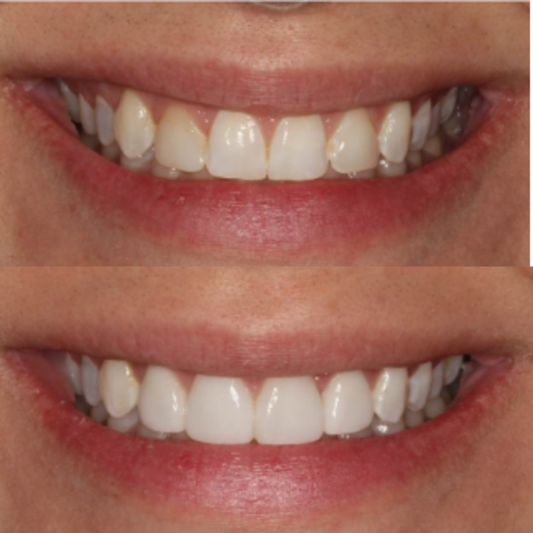 Before and After #31 Before and after of patients Teeth Whitening from Cary Family Dental Cosmetic Dentist in Cary, NC
