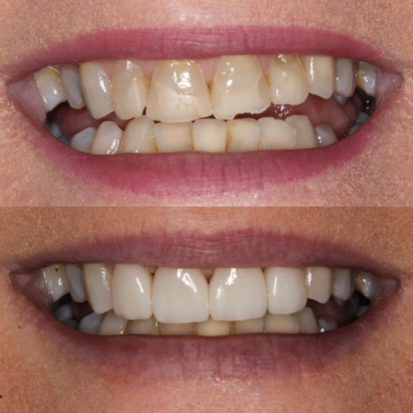 Before and After #34 Before and after of patients chipped tooth repair from Cary Family Dental Cosmetic Dentist in Cary, NC