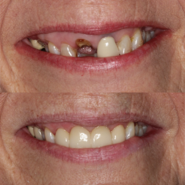 Before and After #36 Before and after of patients broken tooth replacement from Cary Family Dental Cosmetic Dentist in Cary, NC