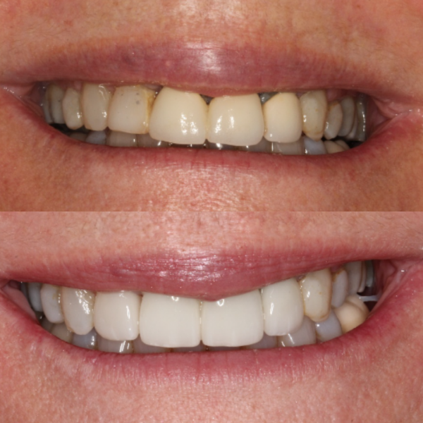 Before and After #37 Before and after of patients Teeth Whitening from Cary Family Dental Cosmetic Dentist in Cary, NC