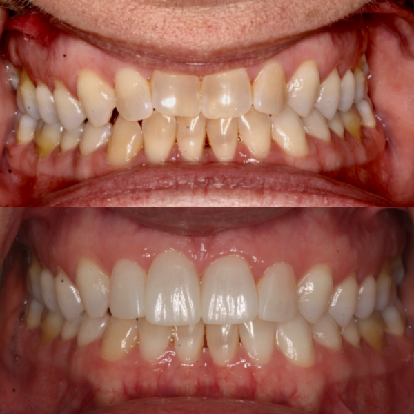 Before and After #40 Before and after of patients Teeth Whitening from Cary Family Dental Cosmetic Dentist in Cary, NC