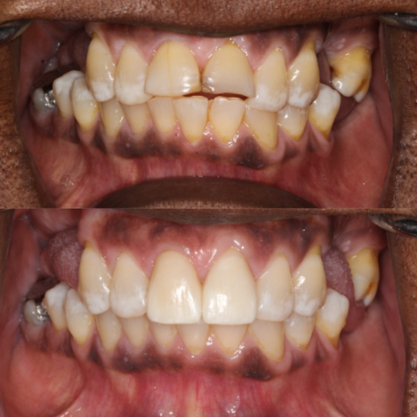 Before and After #43 Before and after of patients Smile Makeover from Cary Family Dental Cosmetic Dentist in Cary, NC