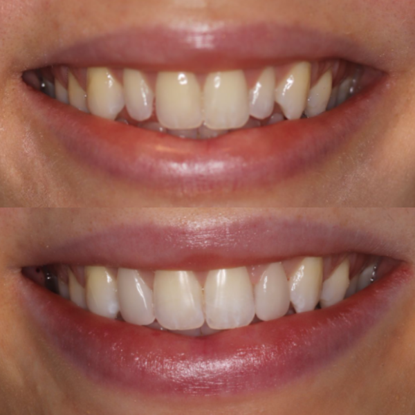 Before and After #44 Before and after of patients Teeth Whitening from Cary Family Dental Cosmetic Dentist in Cary, NC