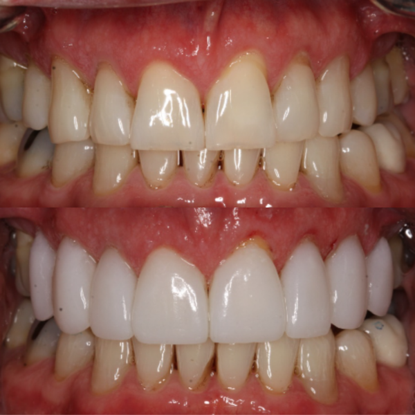 Before and After #48 Before and after of patients Teeth Whitening from Cary Family Dental Cosmetic Dentist in Cary, NC