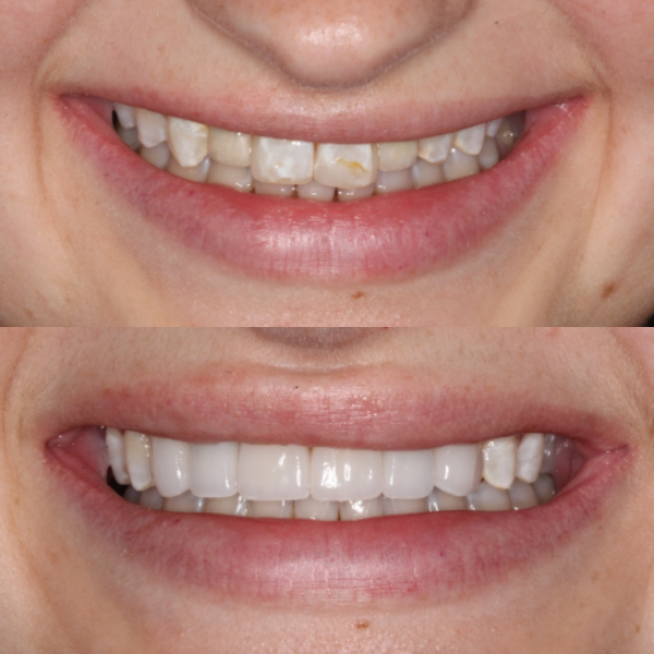 Before and After #5 Before and after of patients smile from Cary Family Dental Cosmetic Dentist in Cary, NC