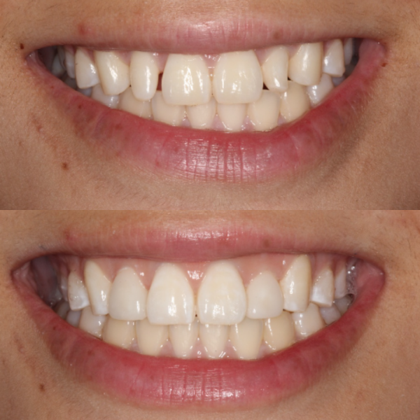 Before and After #50 Before and after of patients Cosmetic Transformation from Cary Family Dental Cosmetic Dentist in Cary, NC