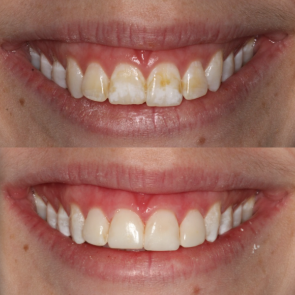 Before and After #53 Before and after of patients Cosmetic Transformation from Cary Family Dental Cosmetic Dentist in Cary, NC