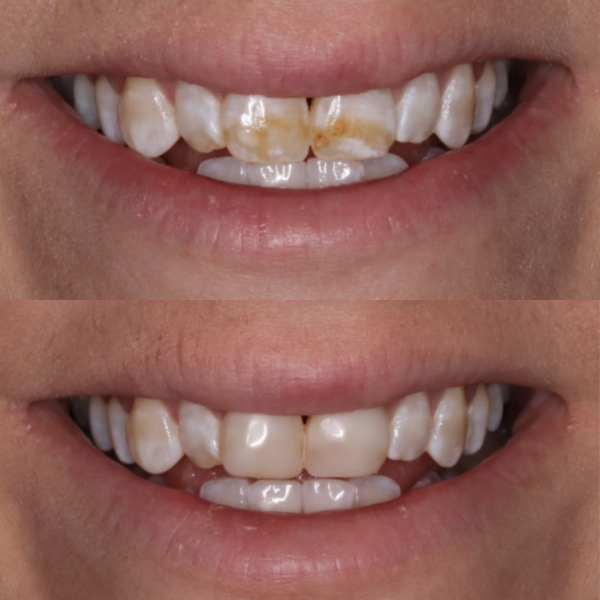 Before and After #54 Before and after of patients Cosmetic Transformation from Cary Family Dental Cosmetic Dentist in Cary, NC