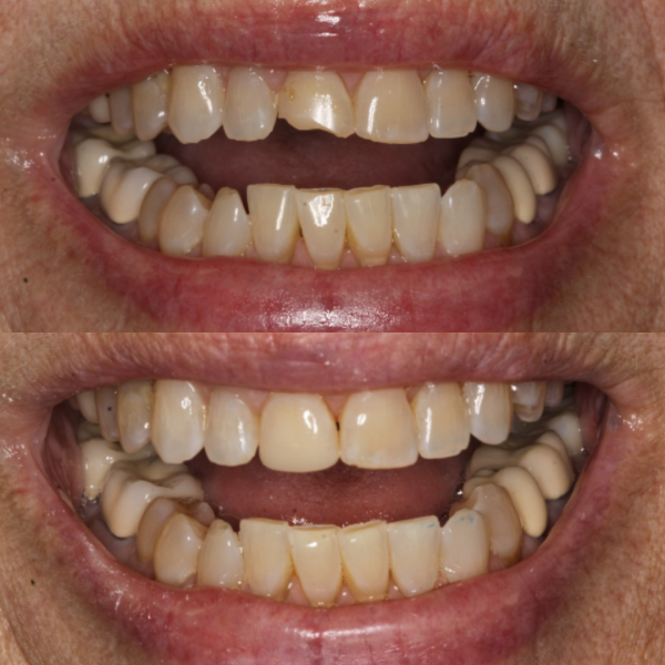 Before and After #55 Before and after of patients Cosmetic Transformation from Cary Family Dental Cosmetic Dentist in Cary, NC