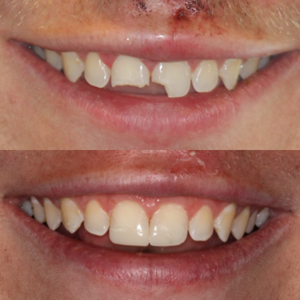 Before and After #57 Before and after of patients Cosmetic Transformation from Cary Family Dental Cosmetic Dentist in Cary, NC