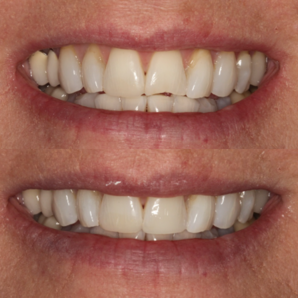 Before and After #58 Before and after of patients Cosmetic Transformation from Cary Family Dental Cosmetic Dentist in Cary, NC