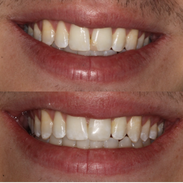 Before and After #60 Before and after of patients Cosmetic Transformation from Cary Family Dental Cosmetic Dentist in Cary, NC