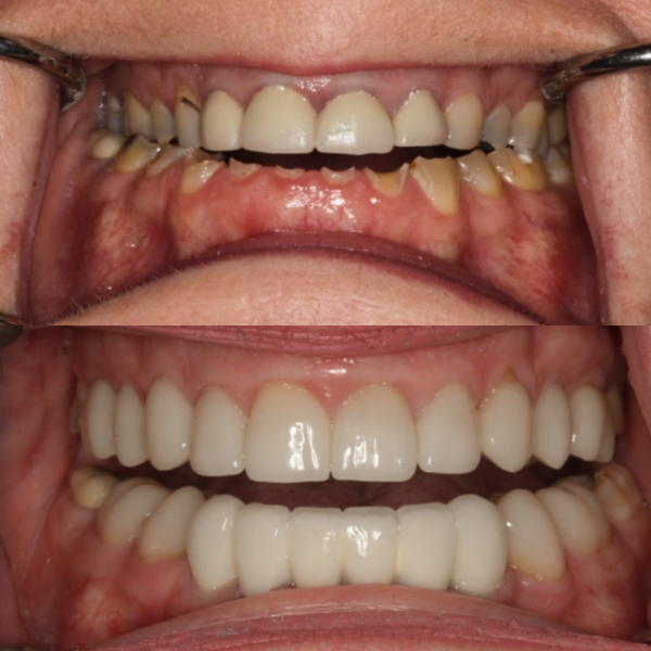 Before and After #7 Before and after of patients broken teeth from Cary Family Dental Cosmetic Dentist in Cary, NC