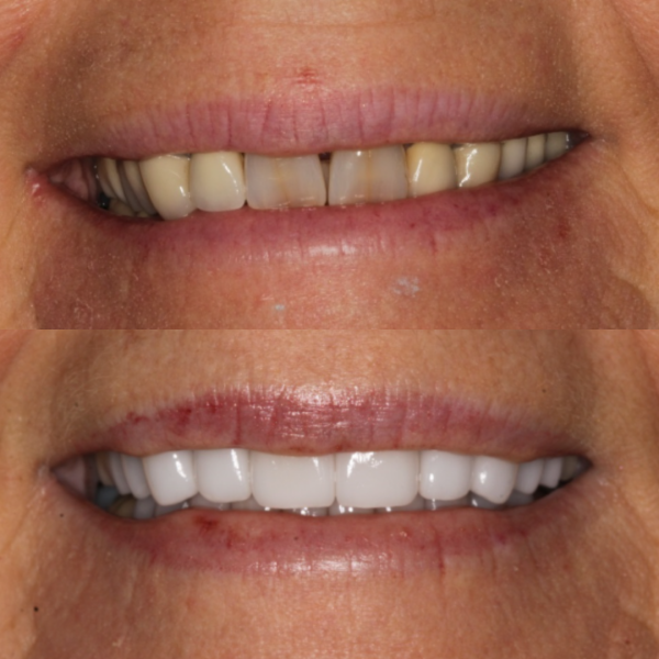 Before and After #8 Before and after of patients smile from Cary Family Dental Cosmetic Dentist in Cary, NC