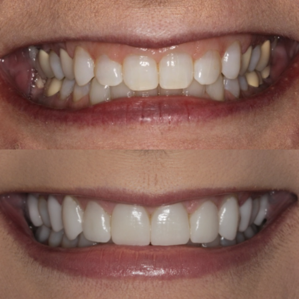Before and After #9 Before and after of patients smile from Cary Family Dental Cosmetic Dentist in Cary, NC