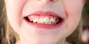 crowded teeth fixed at Cary Family Dental in Cary, NC