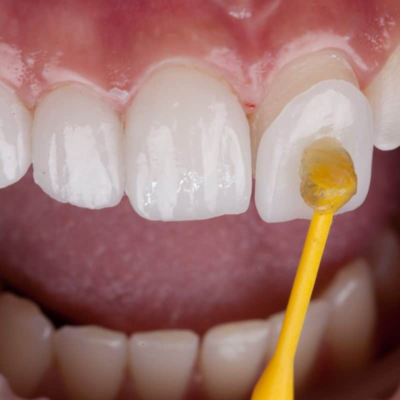 closeup of a dental veneer application