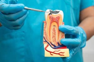 dentist in blue gloves showing a tooth model, infection, need for root canal