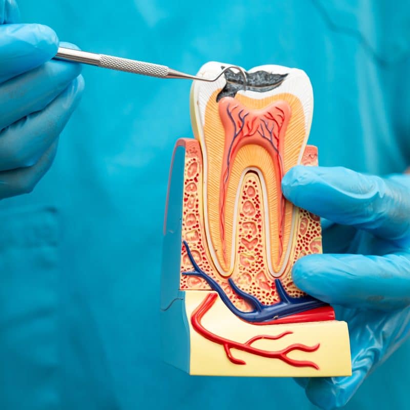 dentist in blue gloves showing a tooth model, infection, need for root canal