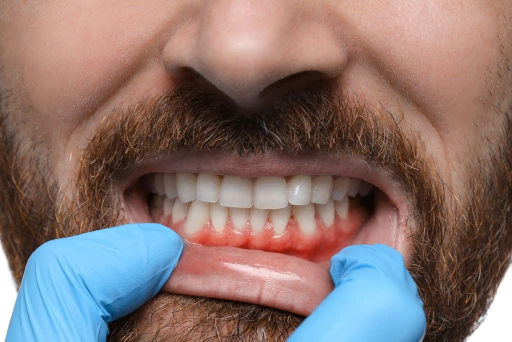 Doctor examining man's inflamed gum, closeup