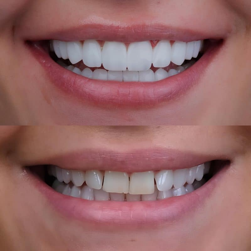 Smile design treatment by a dentist, before and after