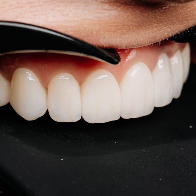 close-up porcelain veneers smiling